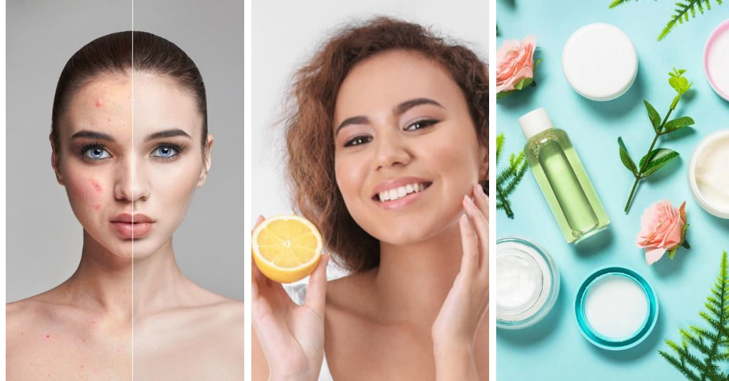 Natural Home Remedies For Pimples and acne