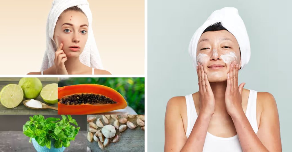 Natural Home Remedies For Pimples and acne