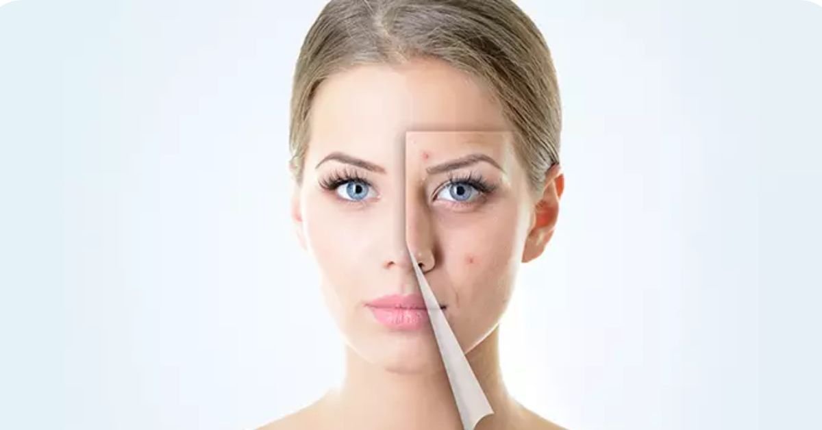 How to avoid pimple?