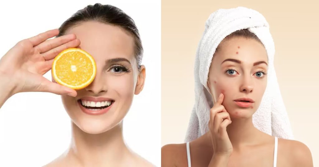 Natural Home Remedies For Pimples and acne