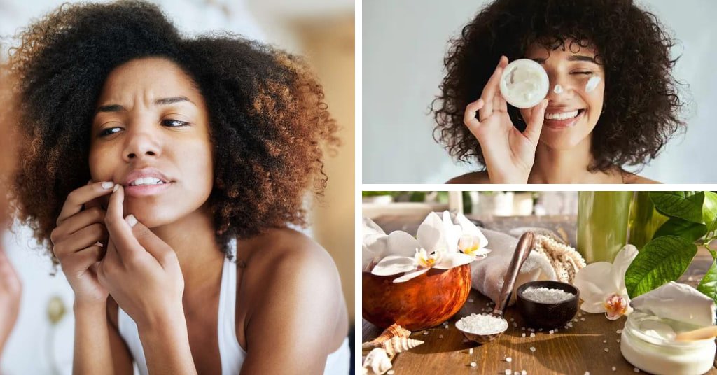 Natural Home Remedies For Pimples and acne