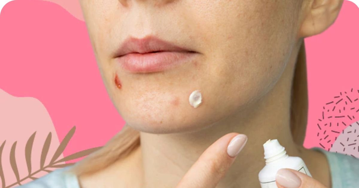 Should you use the toothpaste pimple ?