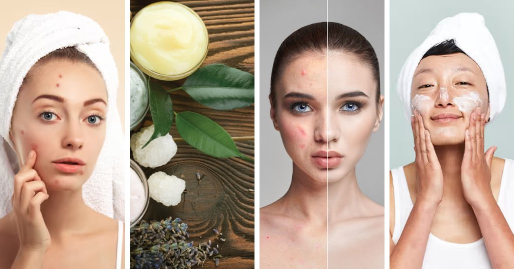  Natural Home Remedies For Pimples and acne