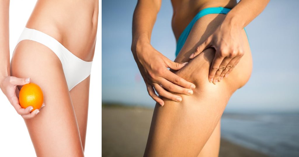 Sleek Stems Top 10 Methods to Disguise Cellulite on Your Legs