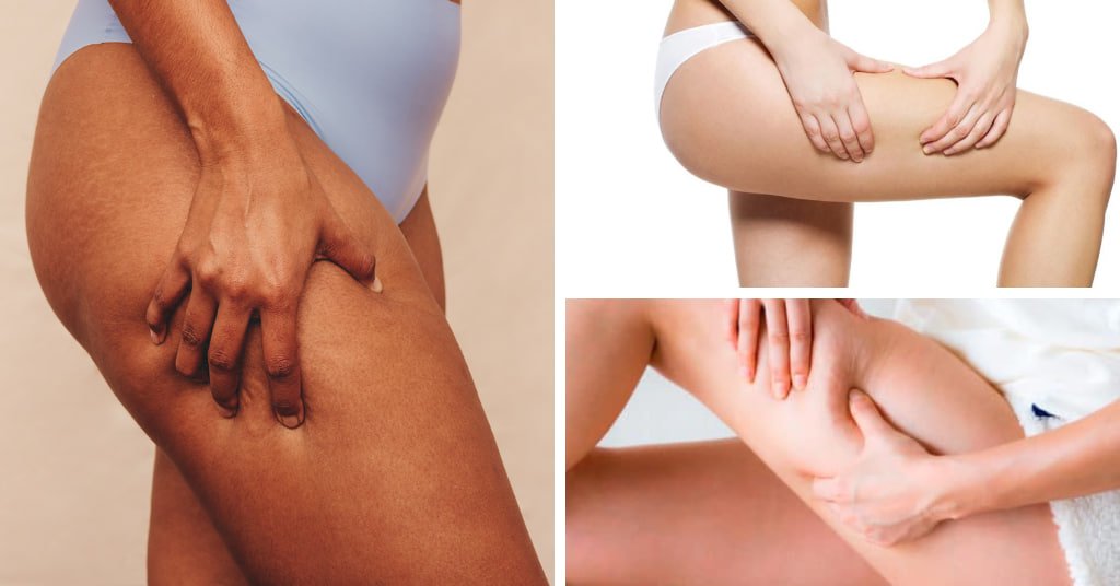 Veil Veins 10 Effective Strategies to Hide Cellulite on Your Legs