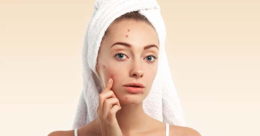 Skincare Mistakes That Cause Acne
